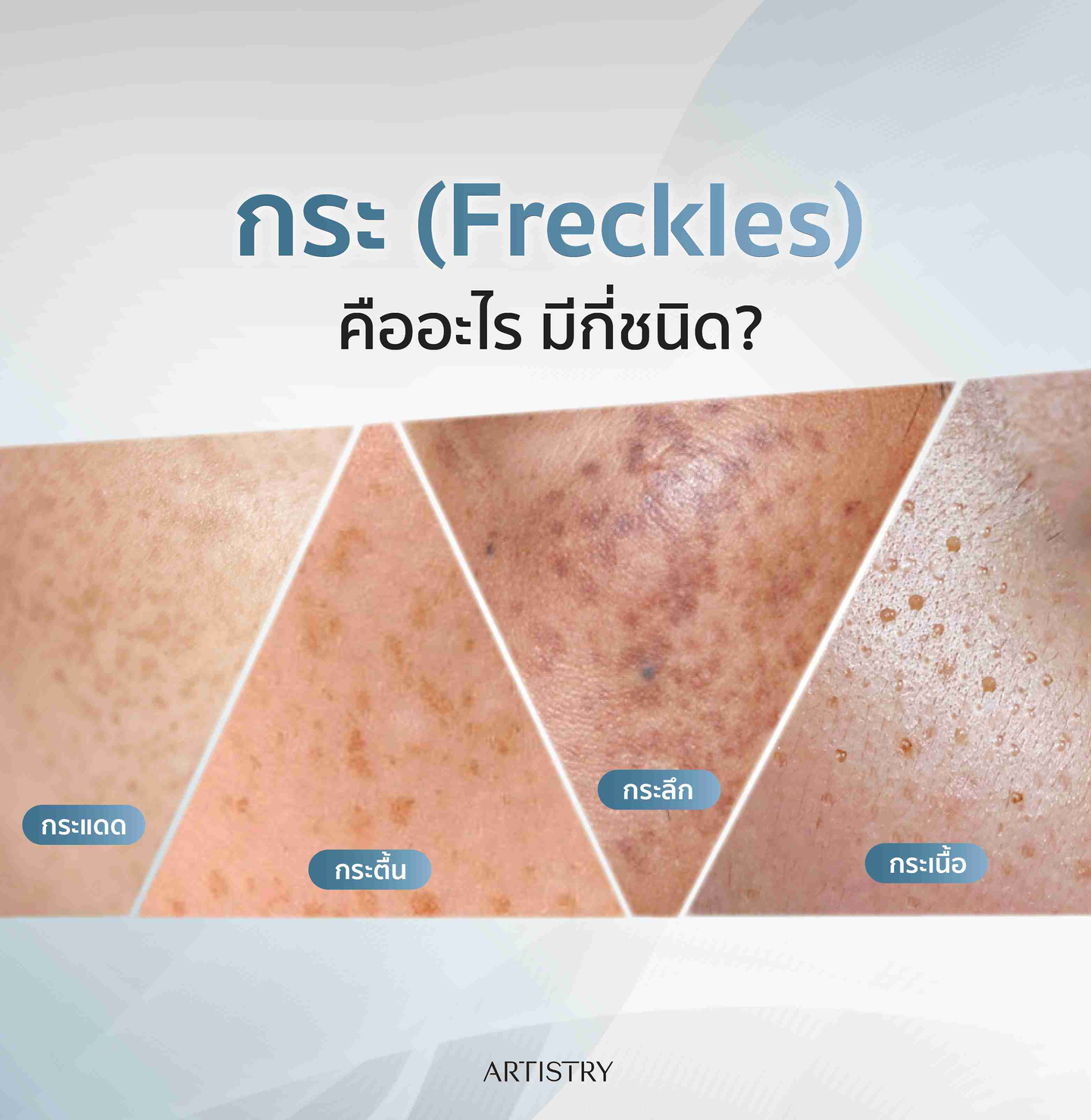 กระ (Freckles) คืออะไร มีกี่ชนิด?